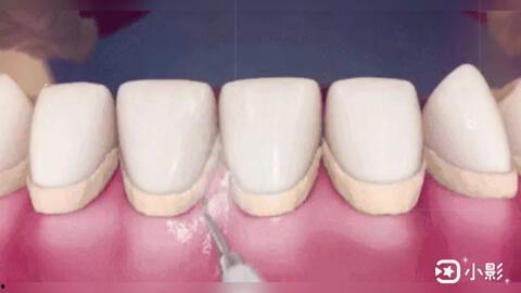 隐形牙套视频,隐形牙套视频揭秘全新矫正体验