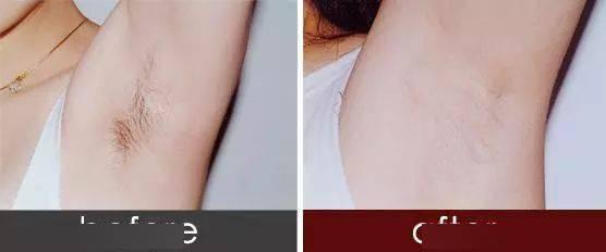 腋下冰点脱毛视频,轻松告别毛发烦恼