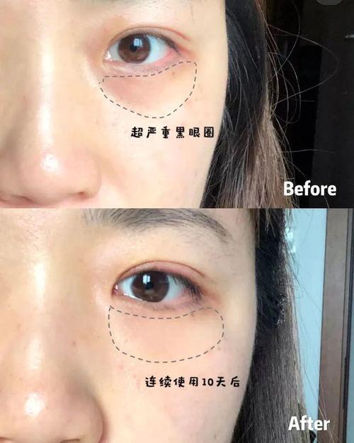 消除眼袋视频,跟随消除眼袋视频教程，重拾明眸光彩
